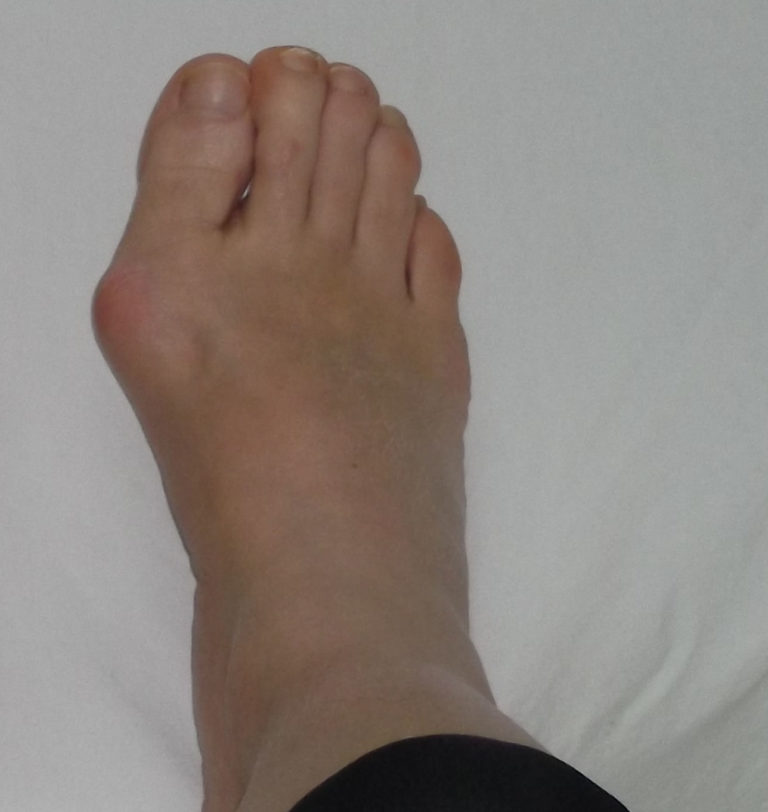 Non-Surgical Bunion Treatment - Innovative Therapy Canada