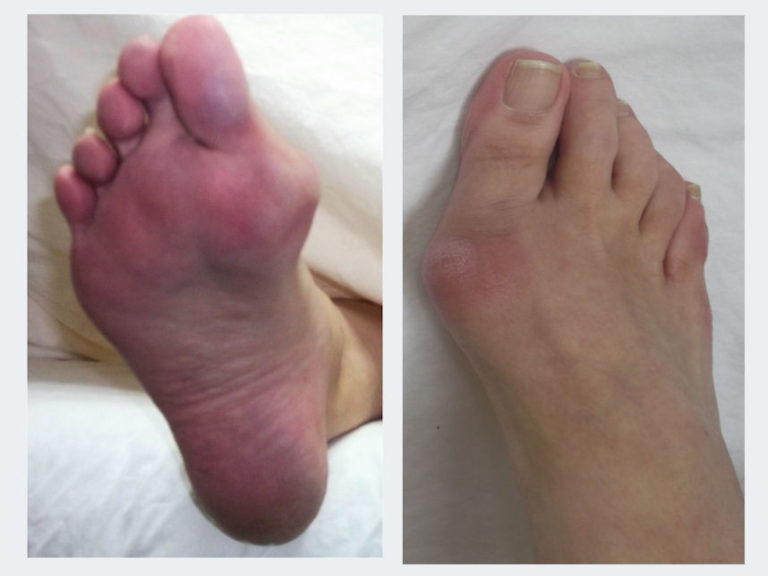 Non-Surgical Bunion Treatment - Innovative Therapy Canada