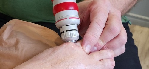 Acoustic Shockwave Therapy Treatment Bunions Innovative Therapy Canada