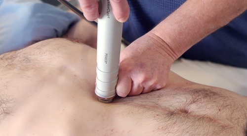 Shockwave Therapy Abdominal Adhesions Treatment Innovative Therapy Canada